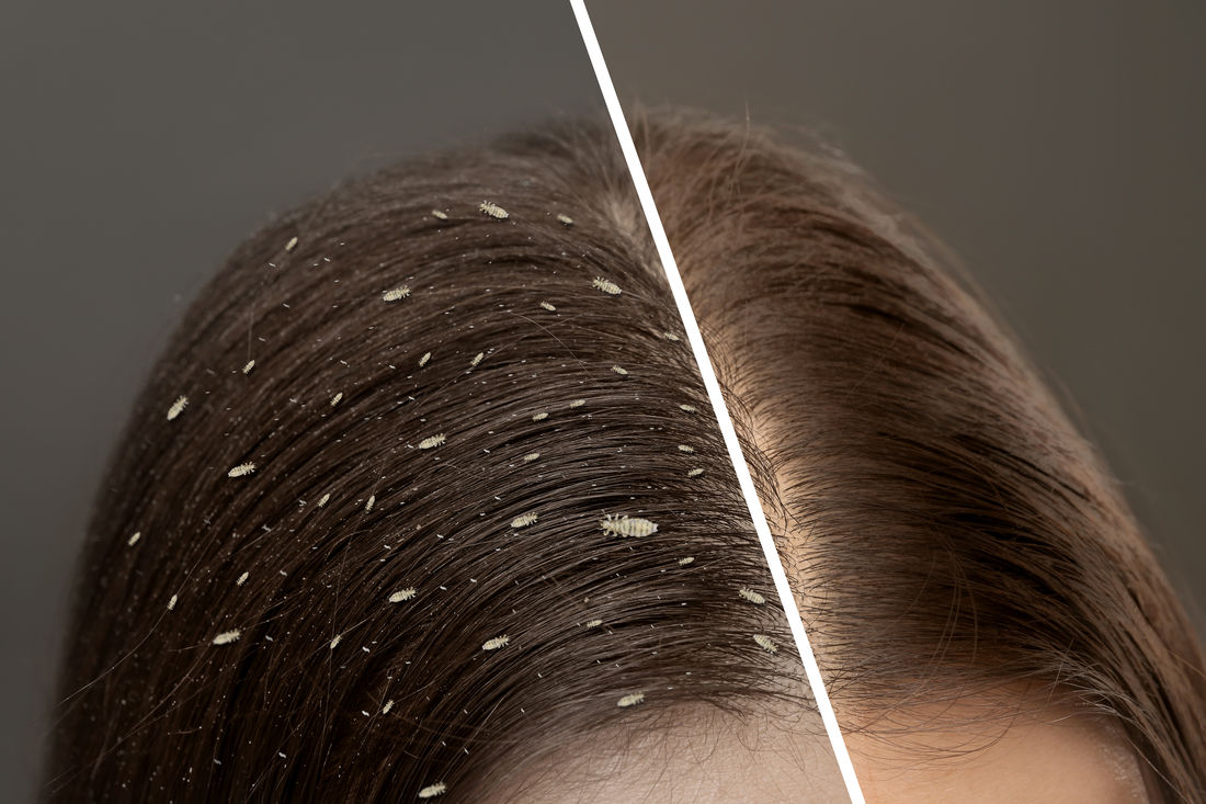 Treatment Costs Head Hunters Lice Removal Service